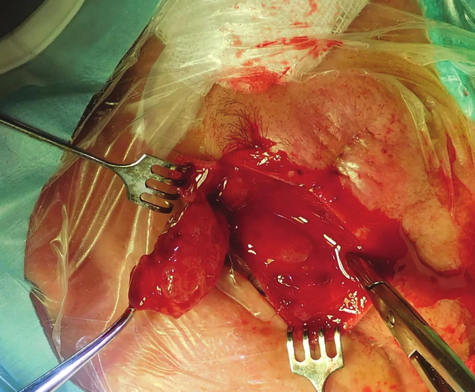 Patient 2 – peroperative findings by Orbitotomy l.sin.