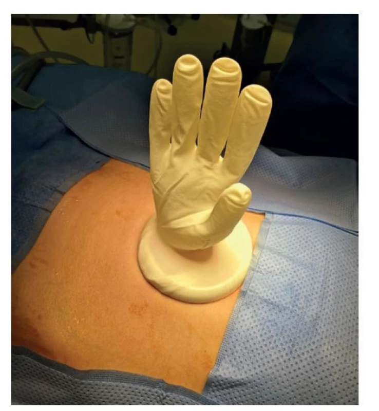 Uzavření retraktoru sterilní rukavicí<br>
Fig. 2: Retractor sealed with a sterile glove