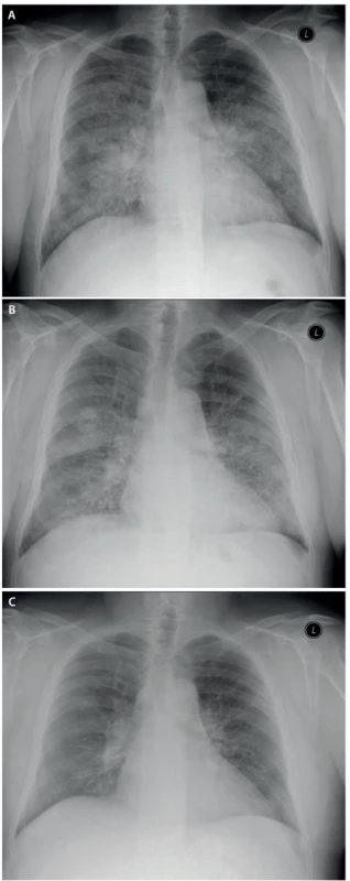RTG snímky plic před léčbou, po 1. a po 2. laváži