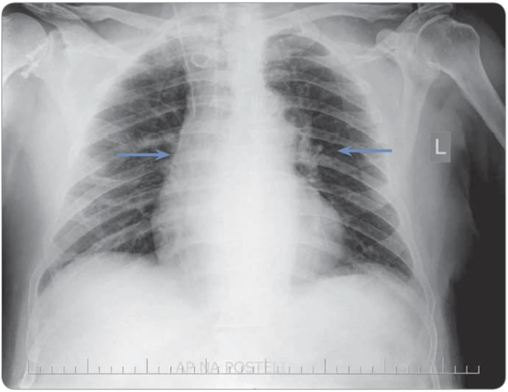 A chest radiograph in an antero-posterior position with the patient in a recumbent position; non-specifi c slightly increased perihilar vessel markings (blue arrows)
are visible.