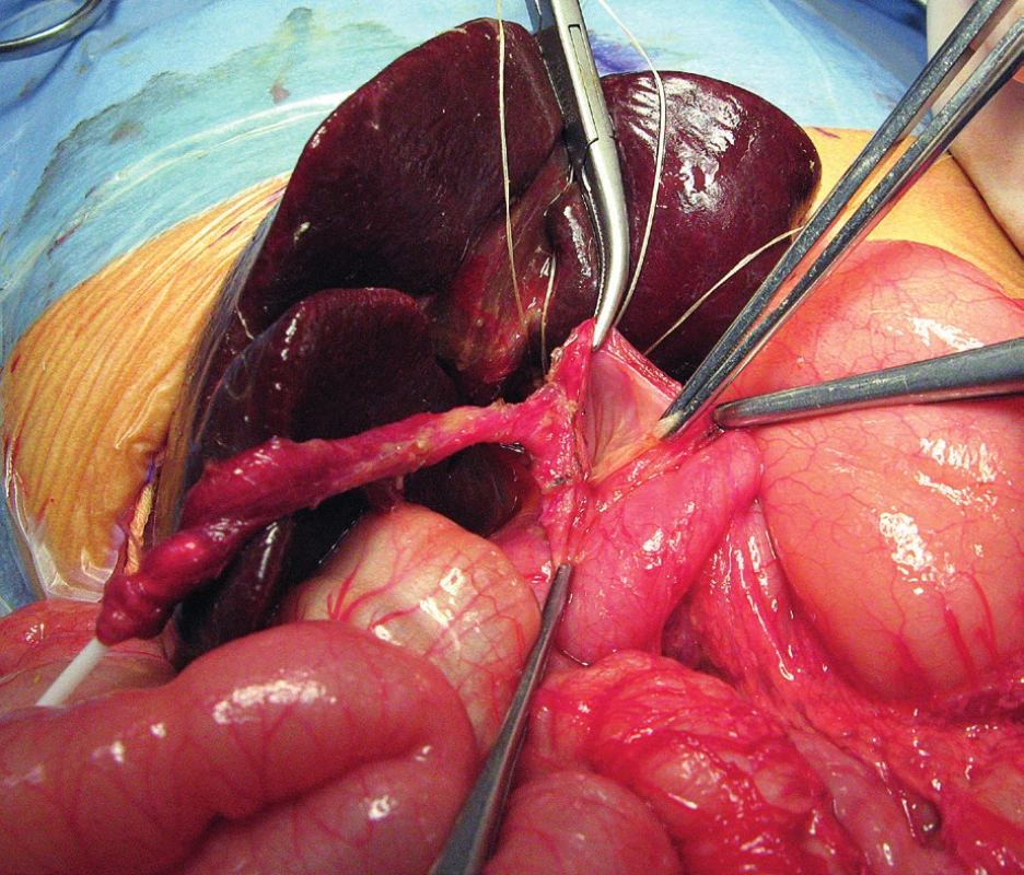 Otvorená operácia vrodenej cystickej malformácie
žlčových ciest.<br>
Fig. 7. Open surgery of congenital biliary cystic malformation.