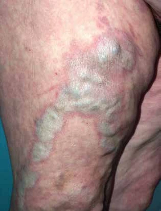 Koebnerův fenomén – lichen sclerosus nad varikózními žilami