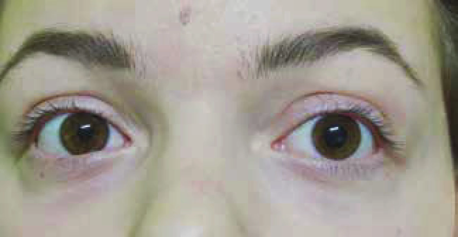 Anizokória pri rozšírení zrenice ľavého oka
u 16 ročnej pacientky