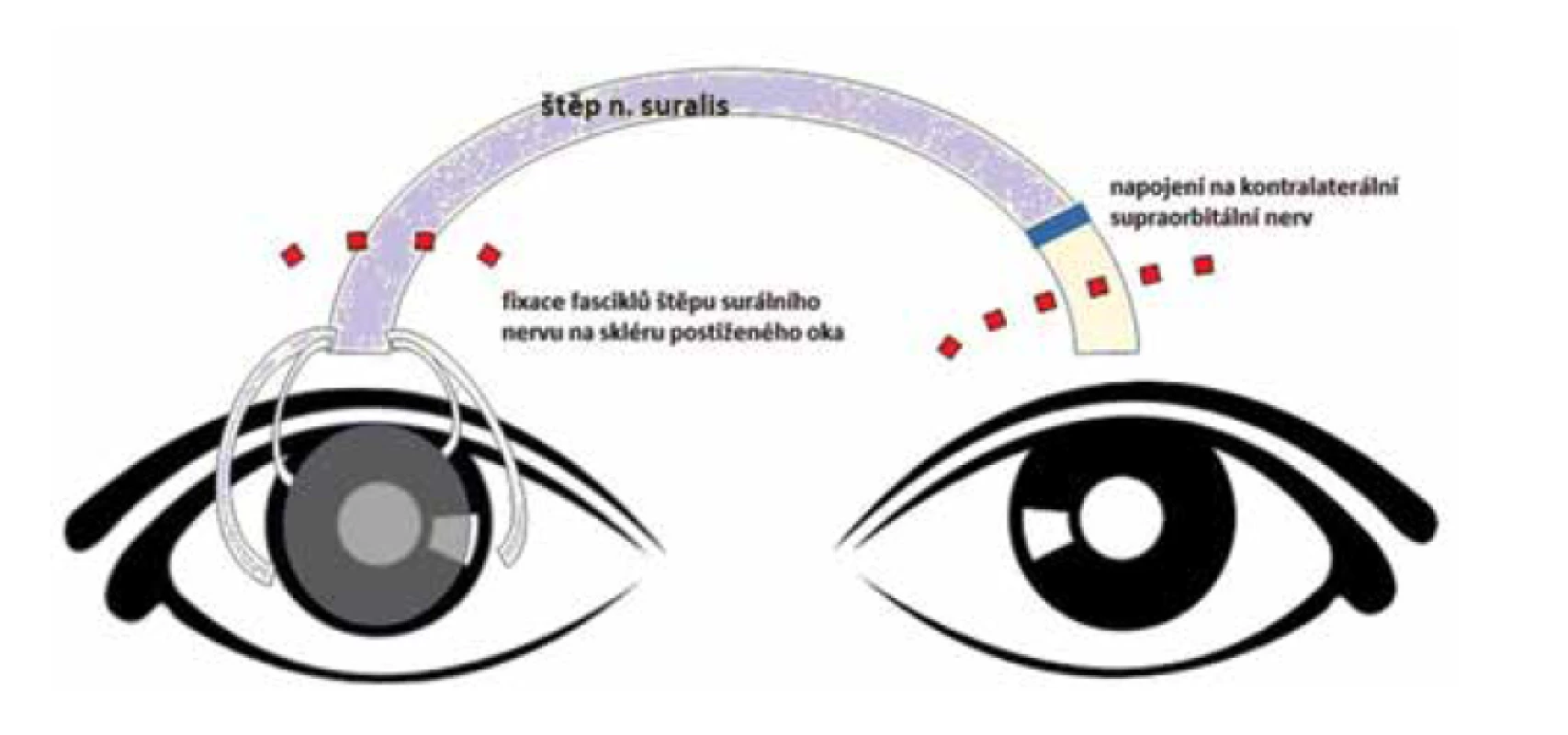 Schéma nepřímé neurotizace rohovky postiženého pravého oka za využití
nervového štěpu a kontralaterálního supraorbitálního nervu