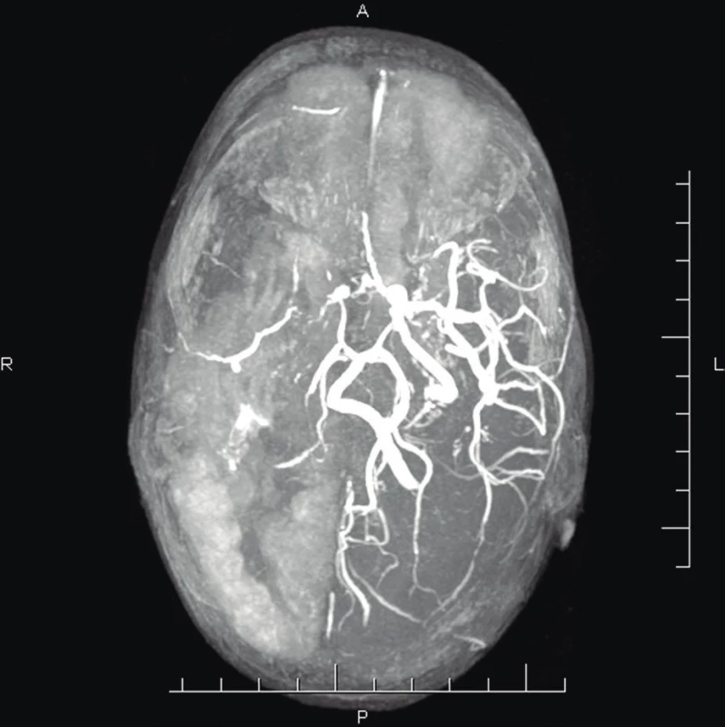 MR-Ag (vo veku 2 r. 3 mes.) – zmeny v cievnom riečisku
pravej hemisféry: filiformná pravá vertebrálna artéria,
chýba prietokový signál ACI l. dx, výrazne redukovaný
prietok pravej strany Willisovho okruhu – ACM
l. dx, ACA dx, chýba prietokový signál periférnych
vetiev ACP dx.<br>
Fig. 5. MR-Ag (age 2 years 3 months) – cerebral arteries
changes in the right hemisphere: filiform stenosis of
the right vertebral artery, missing flow signal of the
right ACI, significantly reduced flow in the right side of
the Willis circle – ACM dx, ACA dx, missing flow signal
of peripheral branches of the ACP dx.