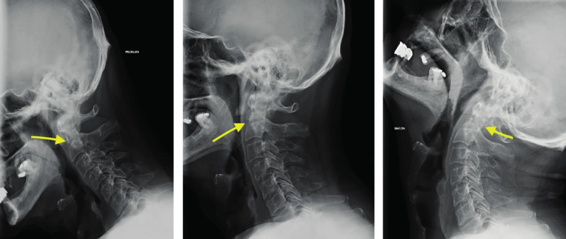 Functional x-ray images of cervical spine acquired 6 months after the odontoid fracture. The arrow shows a still present fracture line in the C2 vertebrae area. However, pathological shift of axis of the affected spinal section is not obvious in the forward and backward bend 