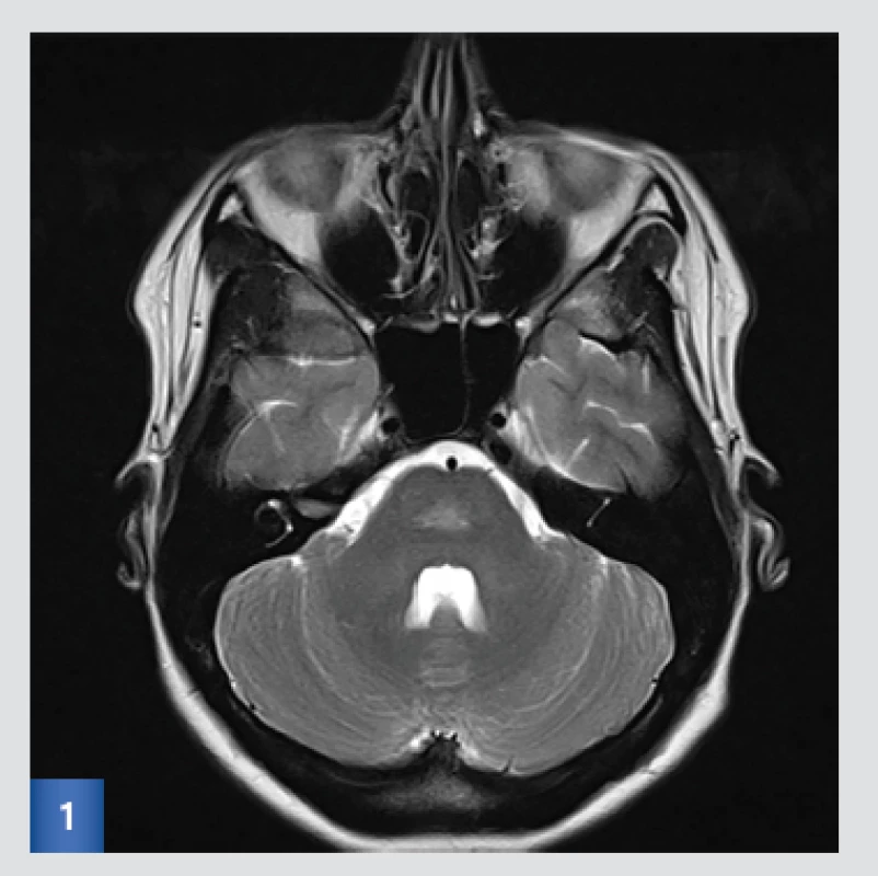 Vstupní MRI: T2-vážený obraz