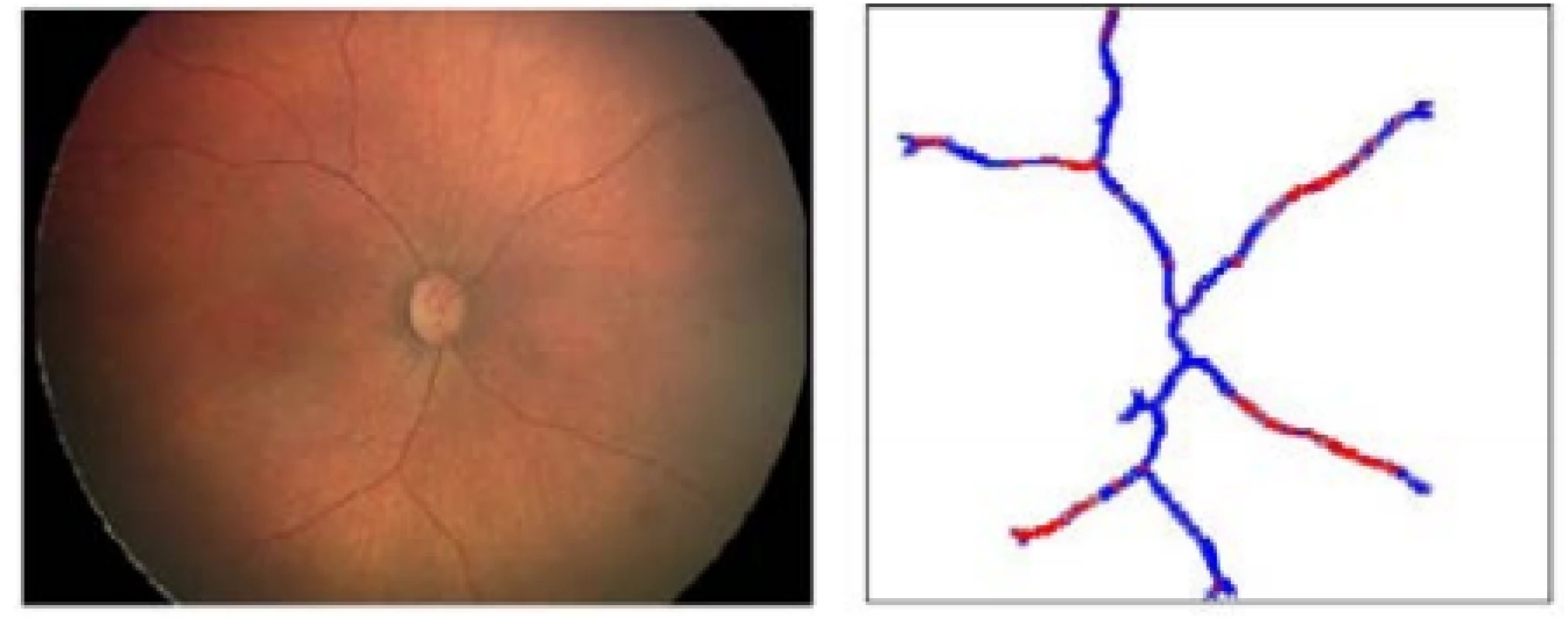 Native image (left), multiple thresholding of
tortuosity in retinal blood vessels image (right)