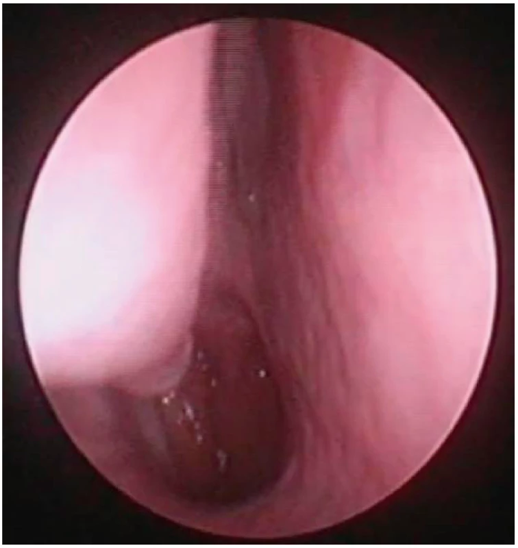 Pohled do nosní dutiny vpravo, endoskopická skupina<br>
I – bez vybočení nosní přepážky, bez hypertrofie dolní skořepy.