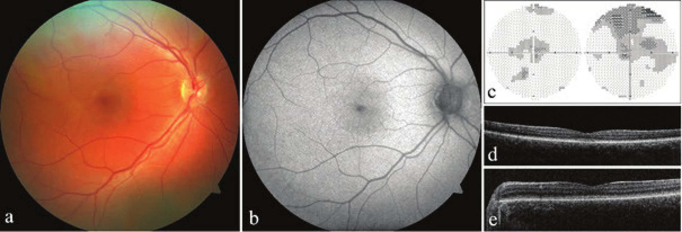 Clinical finding in both probands with achromatopsia. a) photograph of fundus of right eye of proband 1, b) autofluorescence
of fundus of right eye of proband 1, c) perimeter of right and left eye of proband 1, d) optical coherence
tomography with spectral domain (SD-OCT) of left eye of proband 1, d) SD-OCT of left eye of proband 2