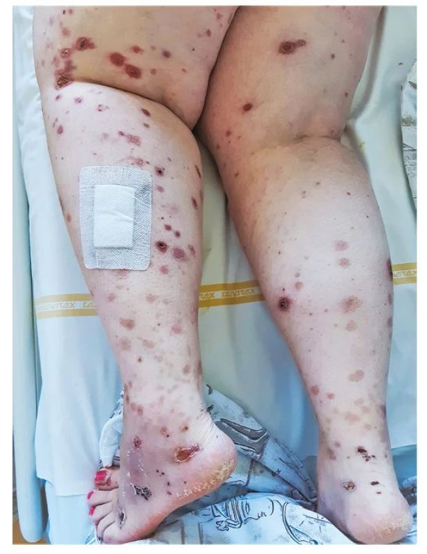 Rozsev kožních vaskulitických eflorescencí na dolních končetinách
43leté nemocné s granulomatózou s polyangiitidou a difuzní alveolární
hemoragií (archiv autorky)