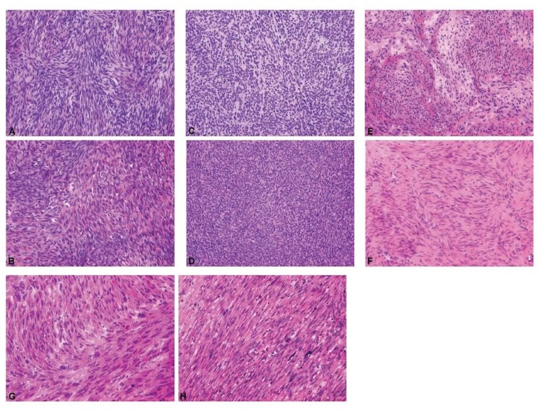 Fascikulárně stavěné gonadostromální a mezenchymální nádory ovaria jako diferenciálně diagnostický problém při peroperačním vyšetření.<br>
A – celulární fibrom (peroperační vyšetření, HE, 200x);
B – celulární fibrom (definitivní vyšetření, HE, 200x);
C – nádor z buněk granulózy, adultní typ, sarkomatoidní
varianta (peroperační vyšetření, HE, 200x); D – nádor
z buněk granulózy, adultní typ, sarkomatoidní varianta
(definitivní vyšetření, HE, 200x); E – leiomyom (peroperační
vyšetření, HE, 200x); F – leiomyom (definitivní
vyšetření, HE, 200x); G – leiomyosarkom (peroperační
vyšetření, HE, 200x); H – leiomyosarkom (definitivní
vyšetření, HE, 200x)