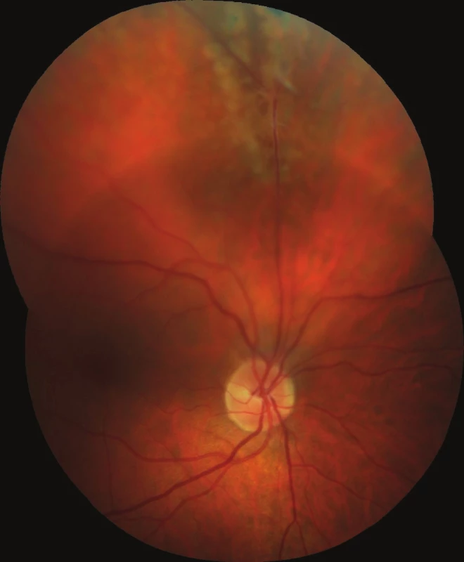 Colour photographic image of fundus of right eye: proximal segment of persistent hyaloid artery binding to upper temporal arcade, with local tractional retinal detachment of an older date