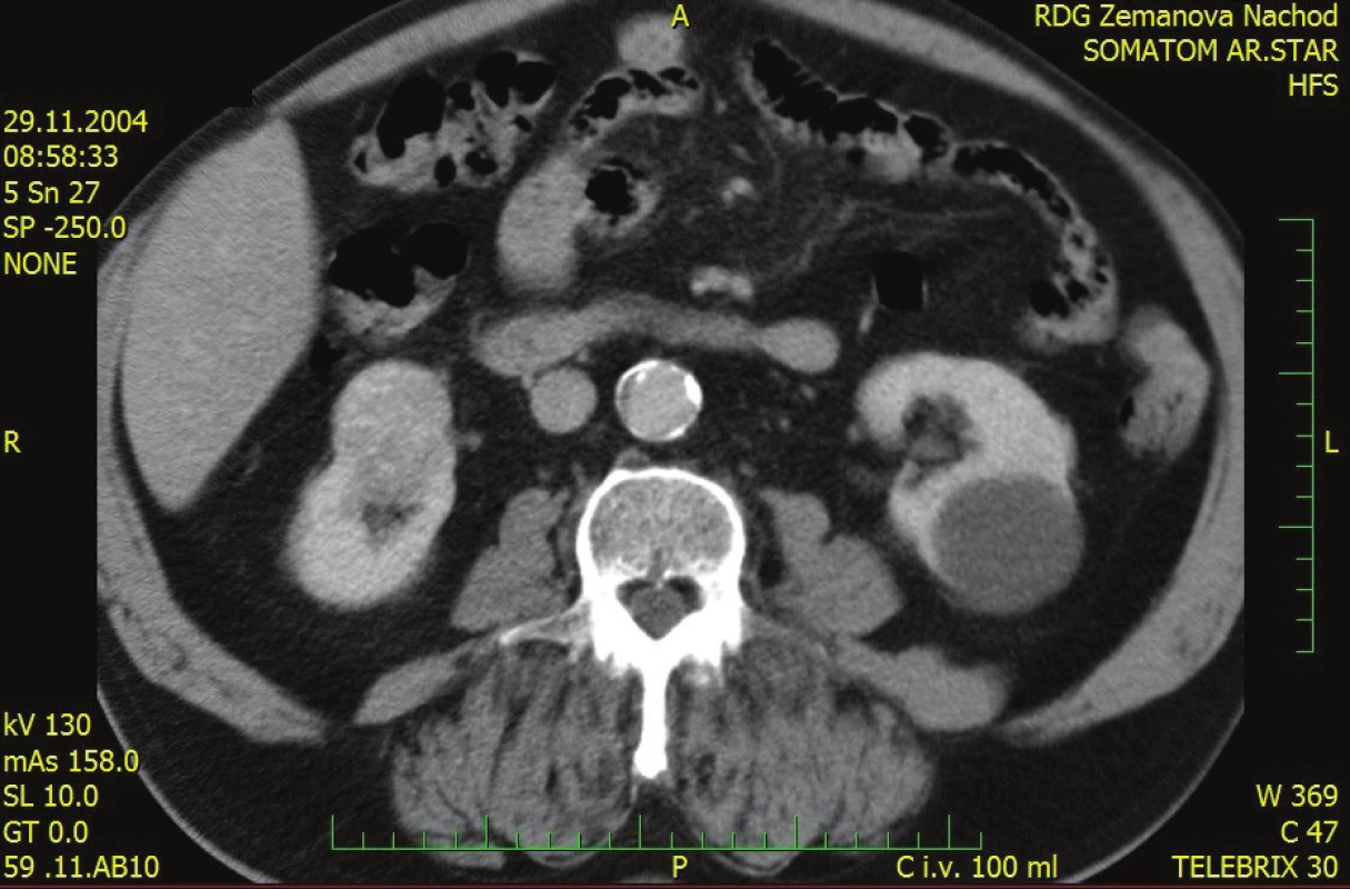 CT břicha, světlobuněčný nádor pravé ledviny<br>
Fig. 1: Abdominal CT – RCC l.dx.