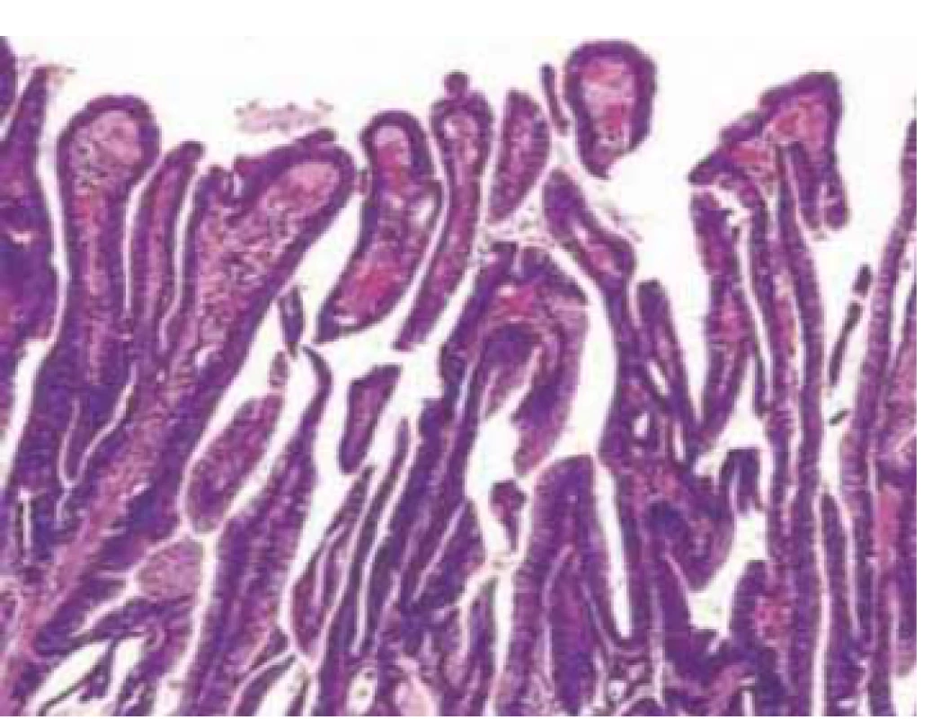 Histologic picture of papillary
gastric adenocarcinoma (hematoxyline-
eosin staining, magnifi cation
200×).<br>
Obr. 6. Histologický obraz papilárneho
adenokarcinómu žalúdka (hematoxylín-
eozín barvenie, zväčšenie 200×).