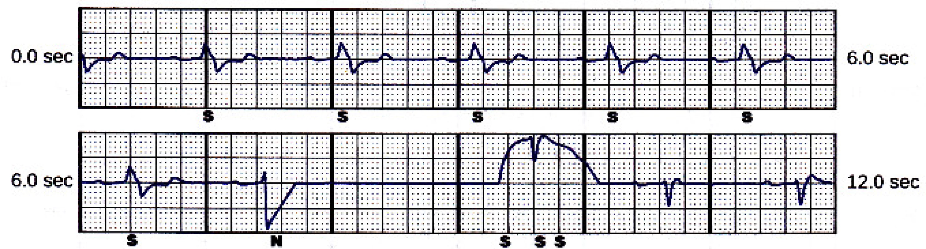 Alternate sensing vector snapshot. Beat
marked “N” is noise