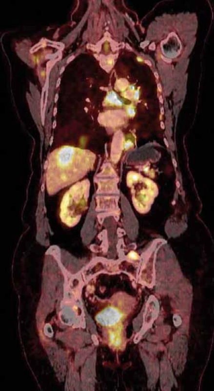 PET/CT zobrazení mnohočetného
postižení žaludku, pankreatu a skeletu.