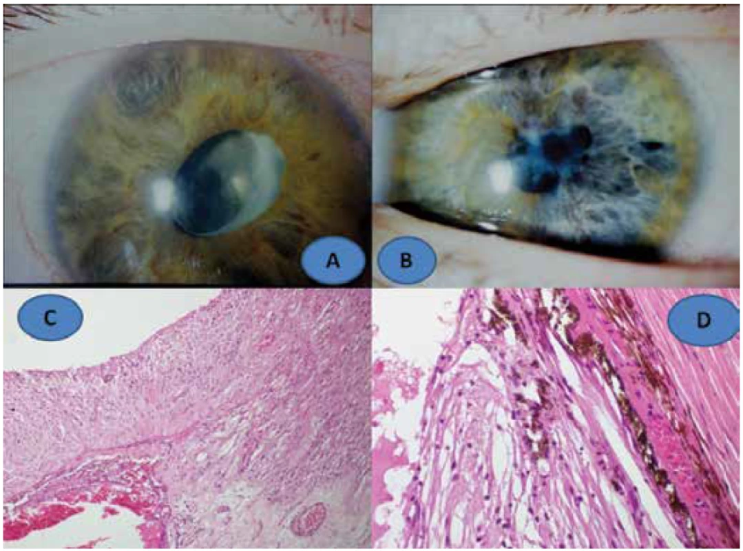 Klinický nález fakoantigenní uveitidy u 14leté dívky: vpravo (A),vlevo (B), histologický
nález: fibrotizované řasnaté tělísko s gliózou amované sítnice, zvětšení 100x, HE (C),
glióza sítnice a fibrotizace cévnatky, zvětšení 400x, HE (D)
