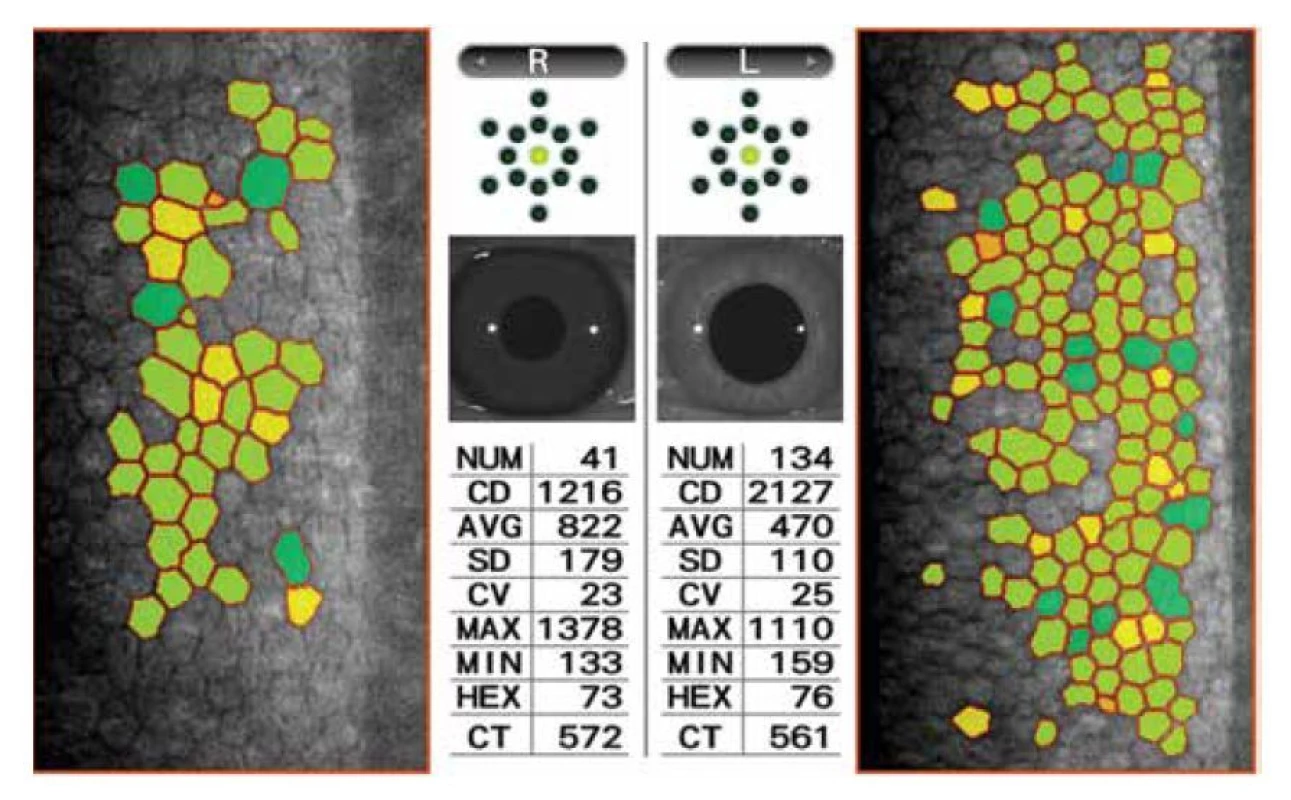 Měření endoteliálních buněk obou očí na spekulárním mikroskopu (CEM-350 NIDEK
CO., LTD.)