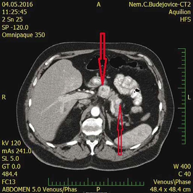 CT s nálezom metastáz pankreasu
(šípky).<br>
Fig. . CT scan shows pancreatic metastases
(arrows).