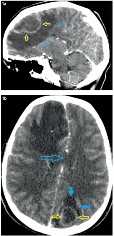 CT mozku při přijetí pacienta (7. 7. 2019).
a – Postkontrastní CT, sagitální rekonstrukce: absces
(46 x 28 x 34 mm) frontálně vpravo (žluté šipky)
s výrazným perifokálním edémem (modré šipky);
b – Postkontrastní CT, axiální rovina: absces okcipitálně
vlevo (26 x 23 x 21 mm, žluté šipky) s výrazným perifokálním edémem (modré plné šipky), přesun středočárových struktur doleva (otevřená modrá šipka). Vpravo
frontálně okrsek edému (hvězdička) v okolí abscesu.<br>
Fig. 1. Brain CT in patient admission (7. 7. 2019). Frontal right-sided abscess (46 x 28 x 34 mm) and occipital left-sided abscess (26 x 23 x 21 mm) with perifocal edema.