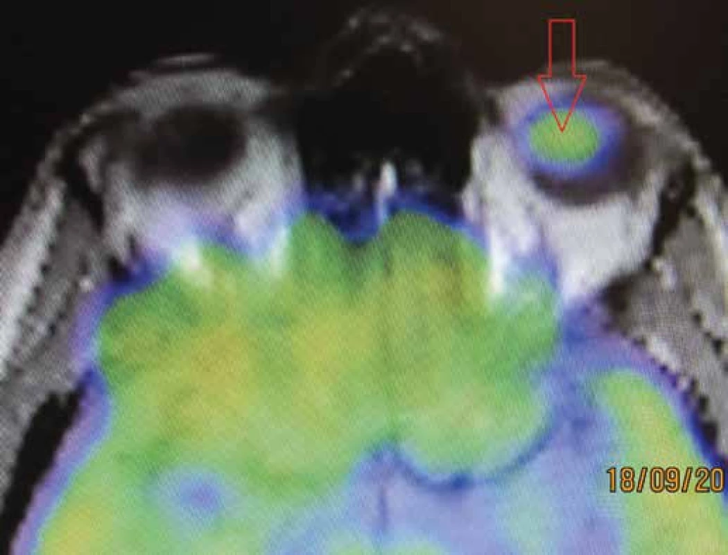 PET/CT vyšetrenie – šípkou označené vychytávanie radiofarmaka v oblasti
uveálneho melanómu
