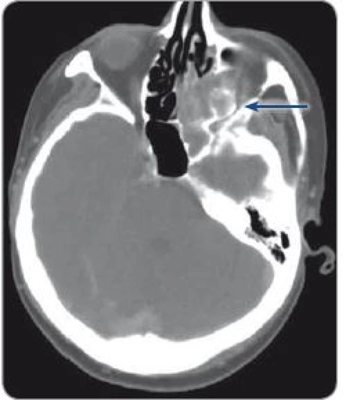 CT prior to surgery with a metastasis in orbit.