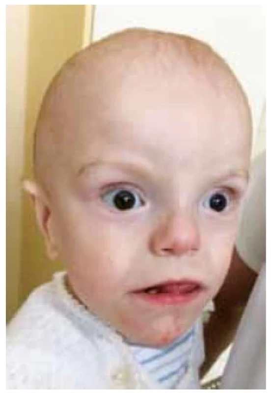 Pacient se Simpsonovým–
Golabiho–Behmelové
syndromem (Rodiče pacienta
poskytli souhlas s publikováním
fotografie)