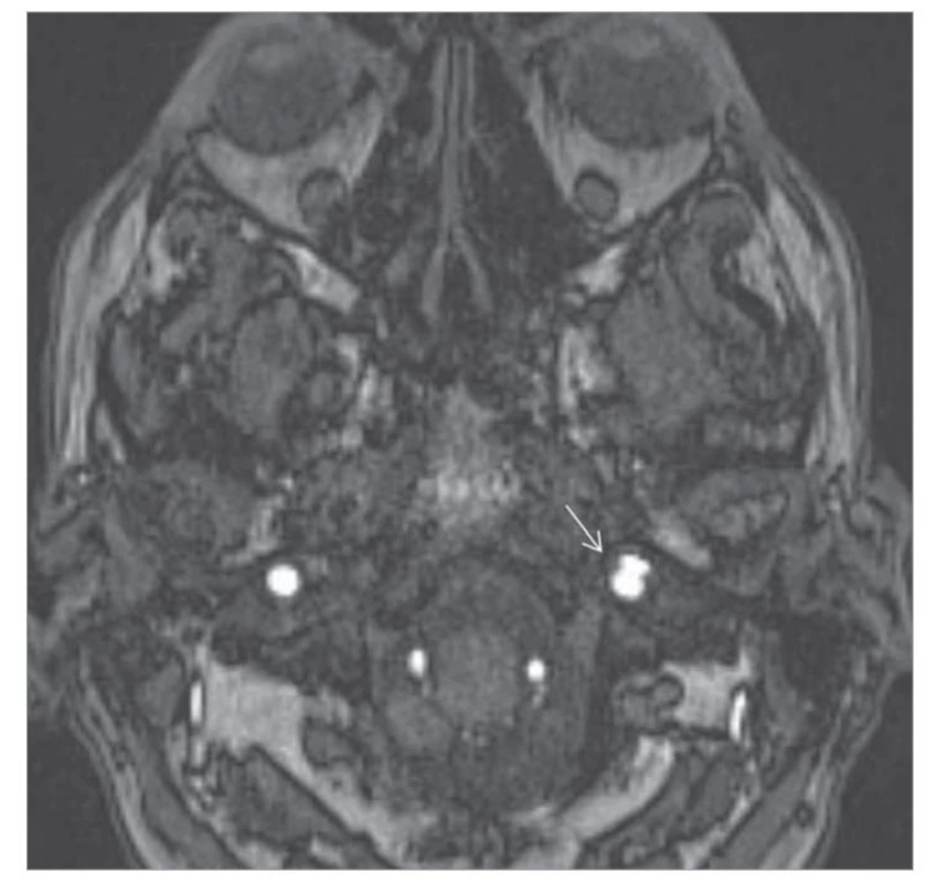 Aneuryzma a. carotis interna vľavo, MR.<br>
Fig. 1. Aneurysm a. internal carotid artery, MR.