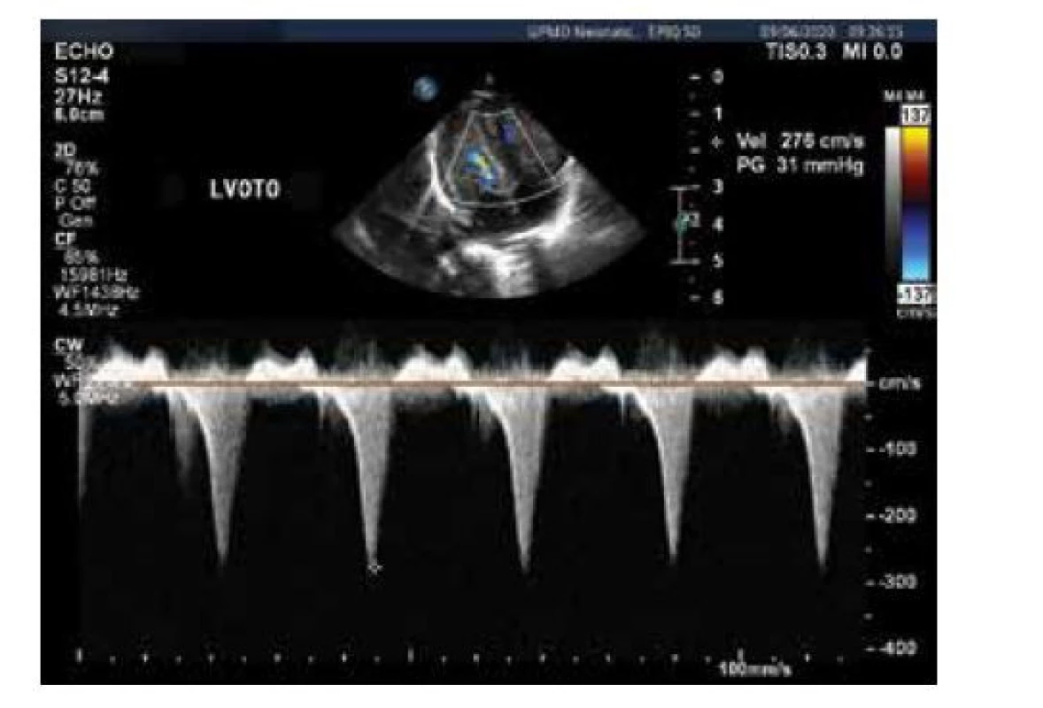 Echokardiografie, CW Doppler, obstrukce výtokového
traktu levé komory s akcelerací toku (tentýž pacient jako na
obr. 4)