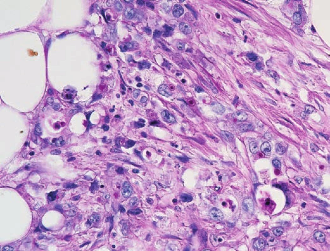 Polymorfní nádorové buňky s prokazatelnou abortivní hlenotvorbou
(PAS pozitivní vakuoly v ojedinělých buňkách) (PAS, 400x).