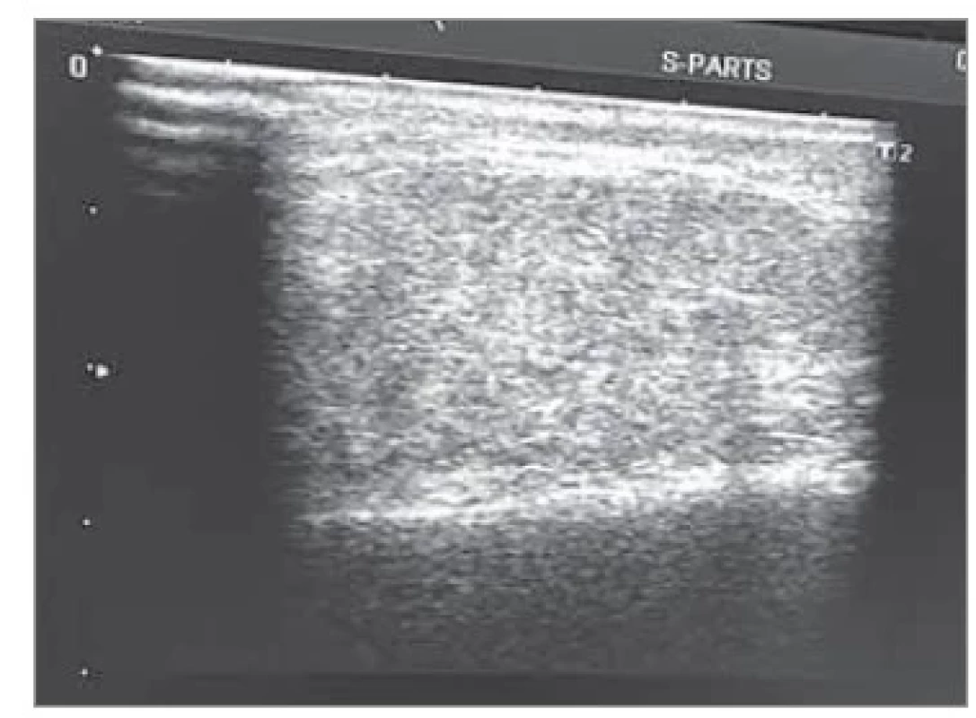 Ultrasonografický nález –
prosáknutí příušní žlázy.<br>
Fig. 1. Ultrasonographic finding –
swelling of the parotid gland.