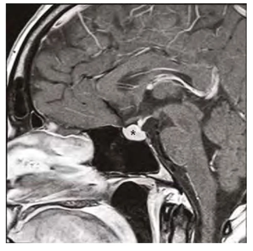 Kontrolní magnetická rezonance mozku (sagitální řez v postkontrastním
T1-váženém obraze) po 3 měsících substituční hormonální léčby,
hvězdička zobrazuje regresi hyperplazie hypofýzy