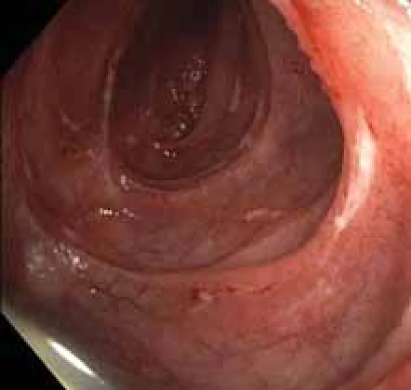 Mnohočetné ulcerace orálního 
jejuna.
Fig. 2. Multiple ulcerations of oral 
jejunum.