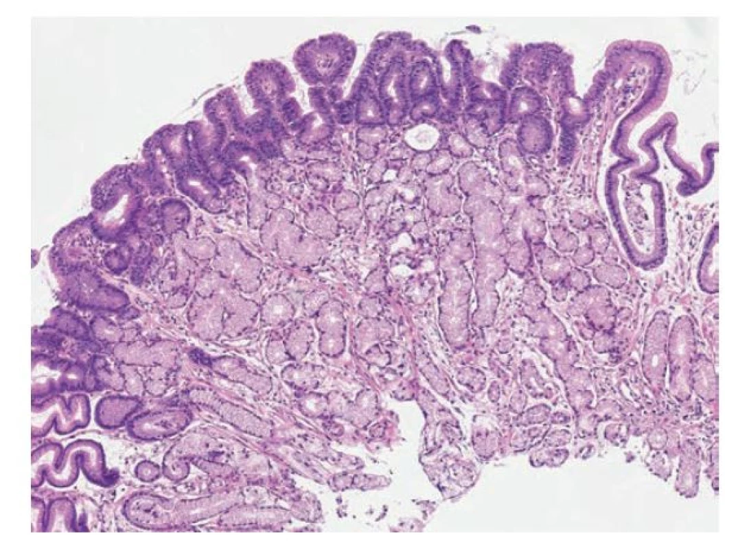 Foveolární dysplázie v žaludku, low-grade. Low-grade foveolární
dysplázie tvořená jednou vrstvou cylindrických foveolárních epitelií s tmavší
cytoplazmou, apikální čepičkou hlenu a zvětšenými oválnými jádry. Vpravo
je patrný je ostrý přechod mezi dysplastickým a nenádorovým foveolárním
epitelem (hematoxylin a eosin, 40x).