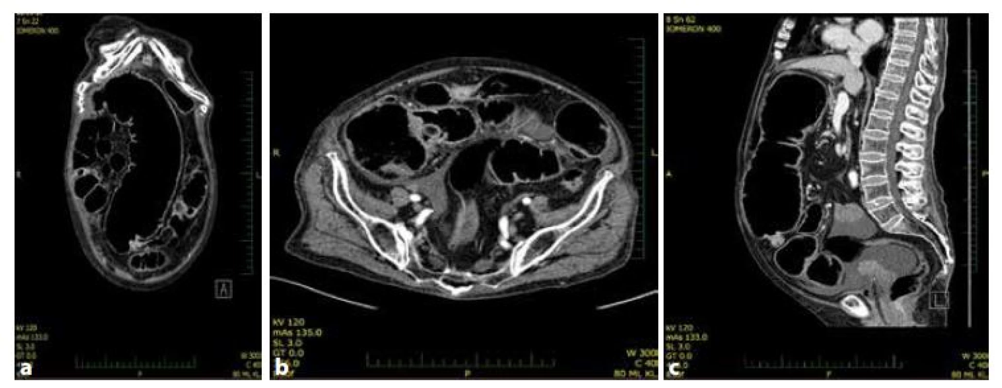 a,b,c: CT nález. Ileózní stav při nádoru c. transversum<br>
Fig. 1a,b,c: CT finding. Large bowel obstruction caused by tumor of transverse colon