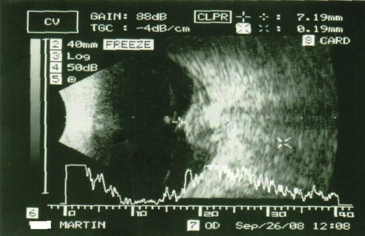 Ultrasound image of tumour deposit above disc of
optic nerve in 2008
