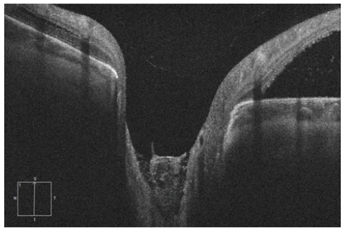 HD-OCT: Lineární vertikální transpapilární sken
levého oka, rozsáhlá JTZN překryta tkání střední reflektivity.
Při horním okraji navazující serózní ablace neuroretiny
s akumulací tekutiny subretinálně