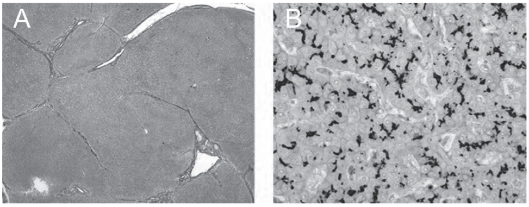 Explanted liver; septal fibrosis (A) and preserved immunohistochemical expression of BSEP along bile canaliculi (B).
(A) Verhoeff’s van Gieson, original magnification x40. (B) Rabbit polyclonal anti-BSEP primary antibody (NBP1-89319, Novus
Biologicals, Abingdon, UK), hematoxylin counterstain; original magnification x400.
