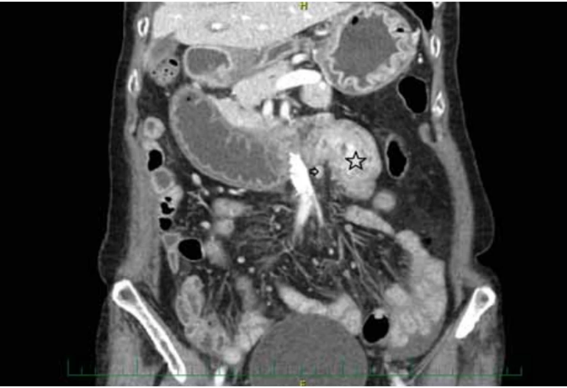CT koronární obraz tumoru tenkého střeva (hvězdička) a onkosuspektních lymfatických uzlin (šipka).
Fig. 1. CT image of small bowel tumor (asterisk) and oncosuspect lymph nodes
(arrow).<br>