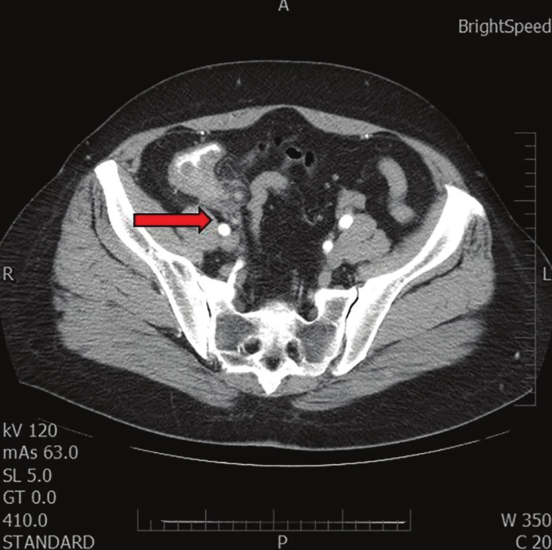 Snímek z CT vyšetření břicha<br>
Červená šipka směřuje na masu v oblasti céka o velikosti přibližně
4 cm, která zdánlivě souvisela s pravým ovariem.<br>
Fig. 1: Abdominal CT imaging<br>
The red arrow marks the mass in the caecal area of size
approx. 4 cm, seemingly related to the right ovary.