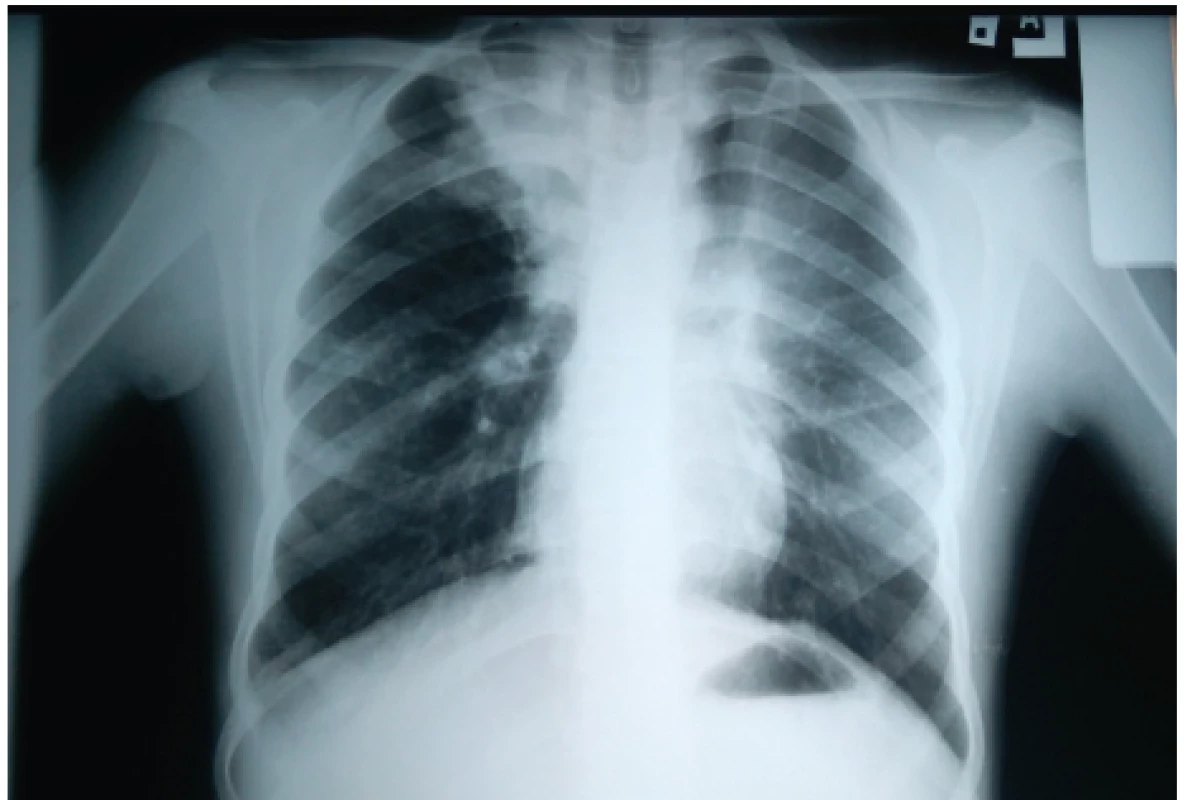 Zápalový infiltrát s atelektázou prítomný v pravom
hornom pľúcnom poli u našej pacientky (#005).<br>
Fig. 1. Pulmonary inflammatory infiltrate with atelectasis present
in the right upper lung field in our patient (#005).