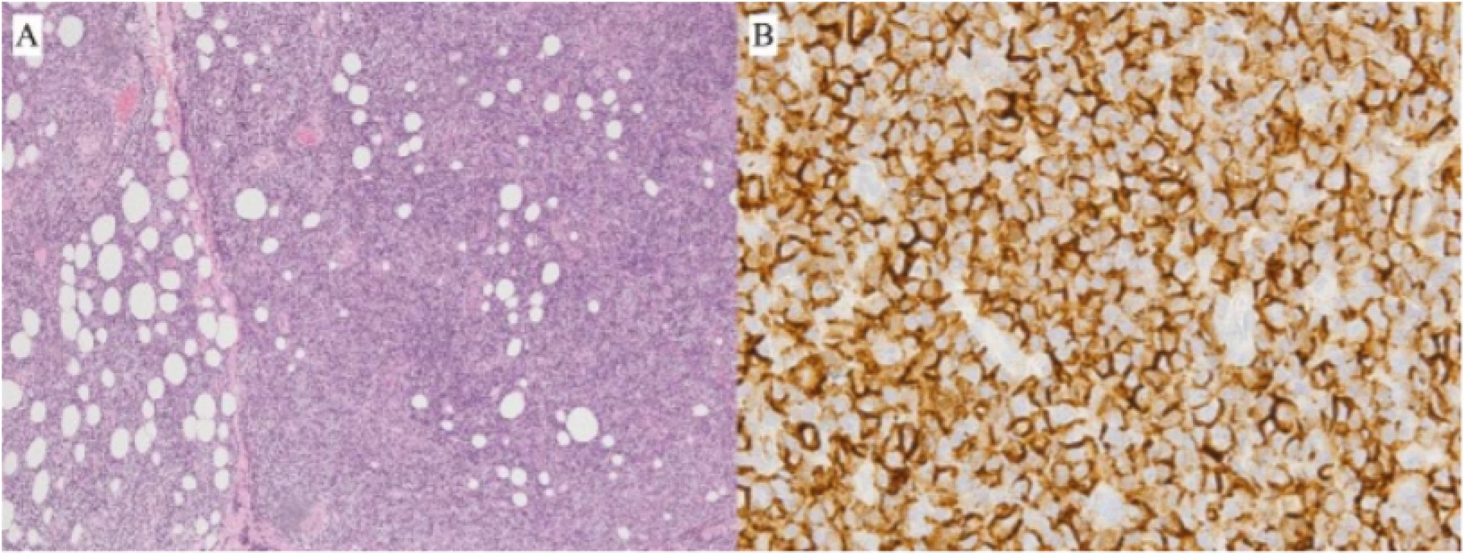 Patient 2 – B-NHL from spectrum of MZBL type malt, biopsy finding:<br>
A) Infiltration of fibrolipomatous conjunctiva with dense, diffuse tumorous lymphoproliferation from<br>
small to medium-sized lymphoid cells (HE, enlargement 100x)<br>
B) Immunohistochemical positivity of CD20+ marker in tumour cells (enlargement 630x)