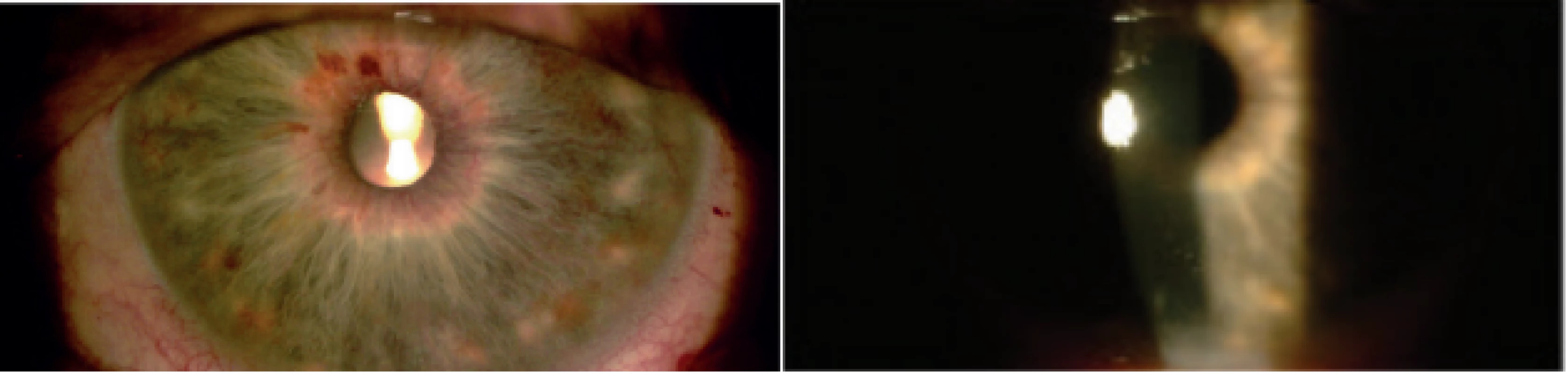 Slight postoperative uveitis. Visible dilatation of vessels of iris and precipitates on cornea visible on first day after cyclophotocoagulation