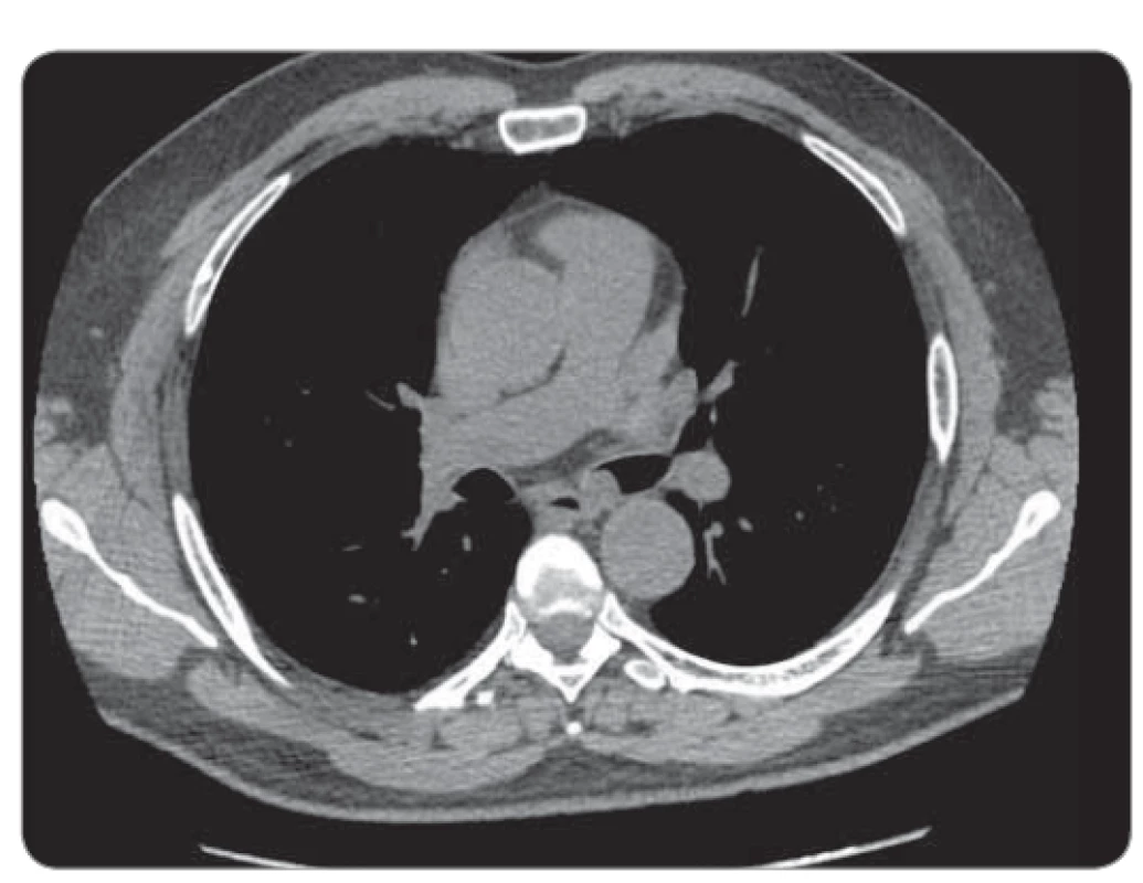 Transverzální CT hrudníku.
