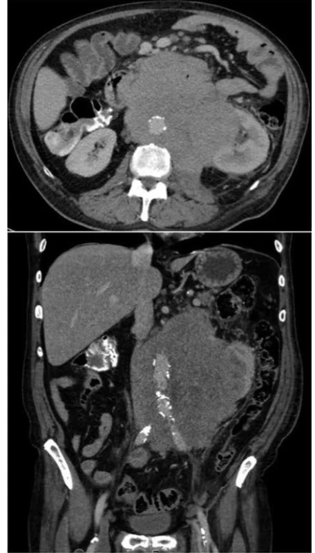 Rozsah postižení dutiny břišní lymfomem<br>
Fig. 3. Extent of tumorous infiltration of patient’s abdomen