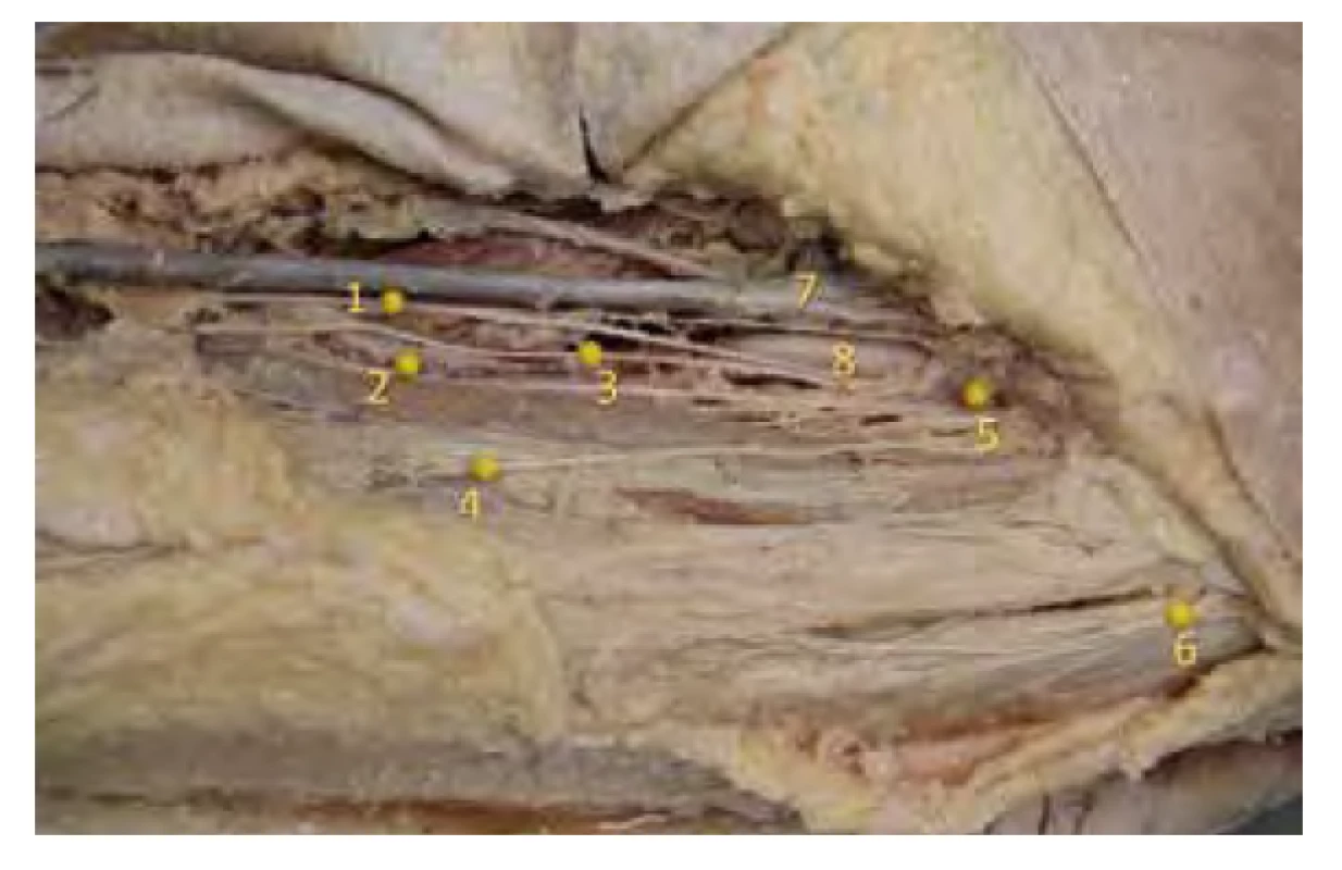 Nervy v trigonu femorale. Anatomický preparát větví femorálního
nervu ve femorálním trojúhelníku a n. cutaneus femoris lateralis.
1. n. saphenus, 2. nerv k m. rectus femoris, 3. nerv k vastus medialis,
4. n. cutaneus femoris anterior, 5. n. femoralis, 6. n. cutaneus femoris, 7. vena
femoralis, 8. arterie femoralis