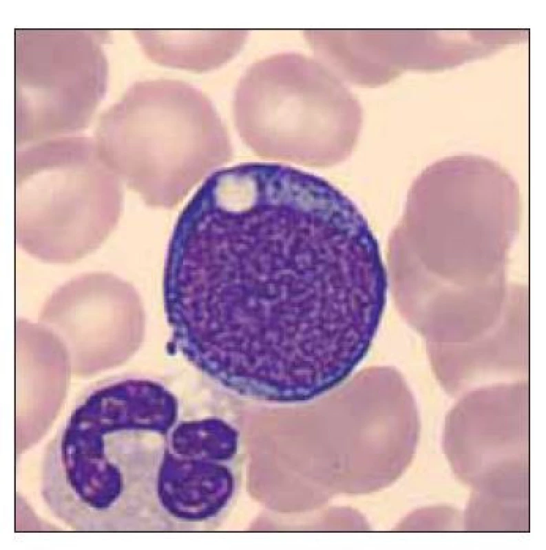 Blastická buňka vzhledu megakaryoblastu, 
segmentovaný neutrofilní
granulocyt s vakuolizací cytoplazmy.