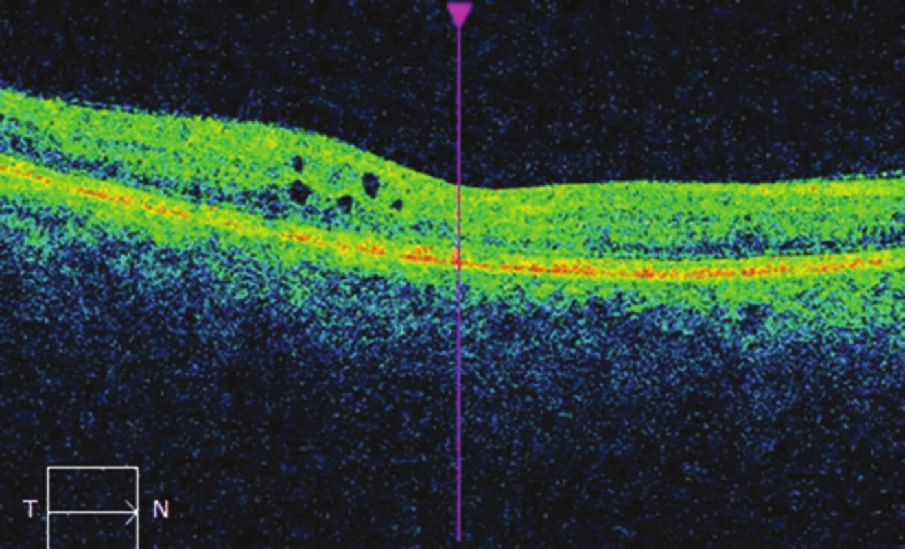 OCT image of right eye after micropulse laser treatment of
the central area: decrease of ocular edema, CRT 266 μm.