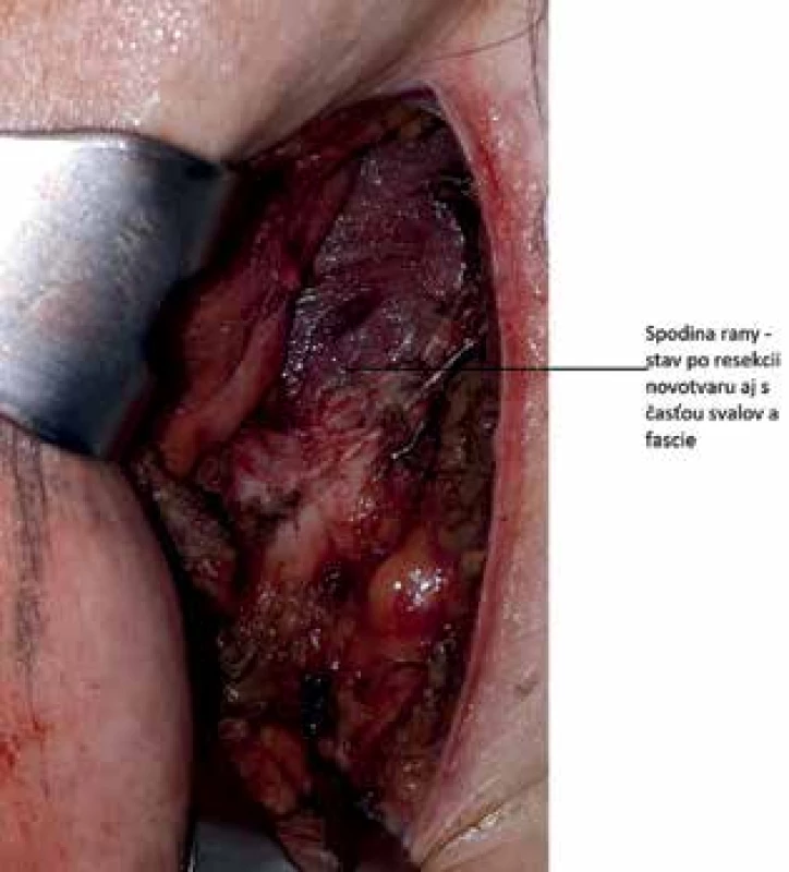 Stav po resekcii tumoru aj s časťou svalovej fascie.<br>
Fig. 3: Wound after tumor resection with part of muscular 
fascia